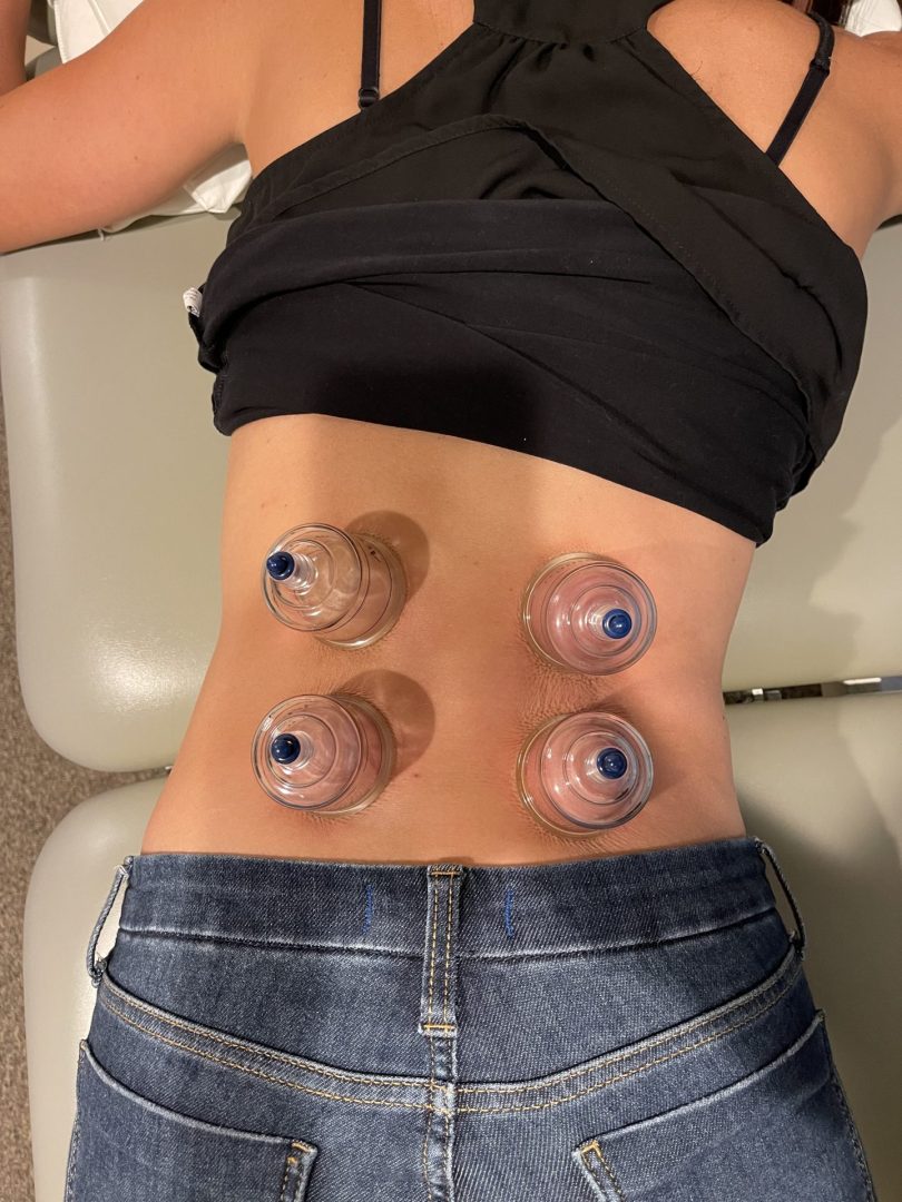 How long do cupping marks last? (Average healing time and easy tips for faster recovery)
