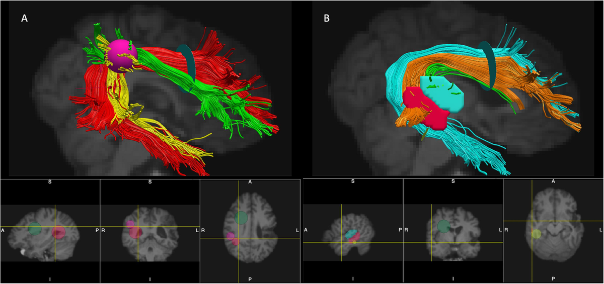 Trouble speaking? How arcuate fasciculus impacts language skills!