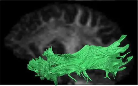 Trouble speaking? How arcuate fasciculus impacts language skills!